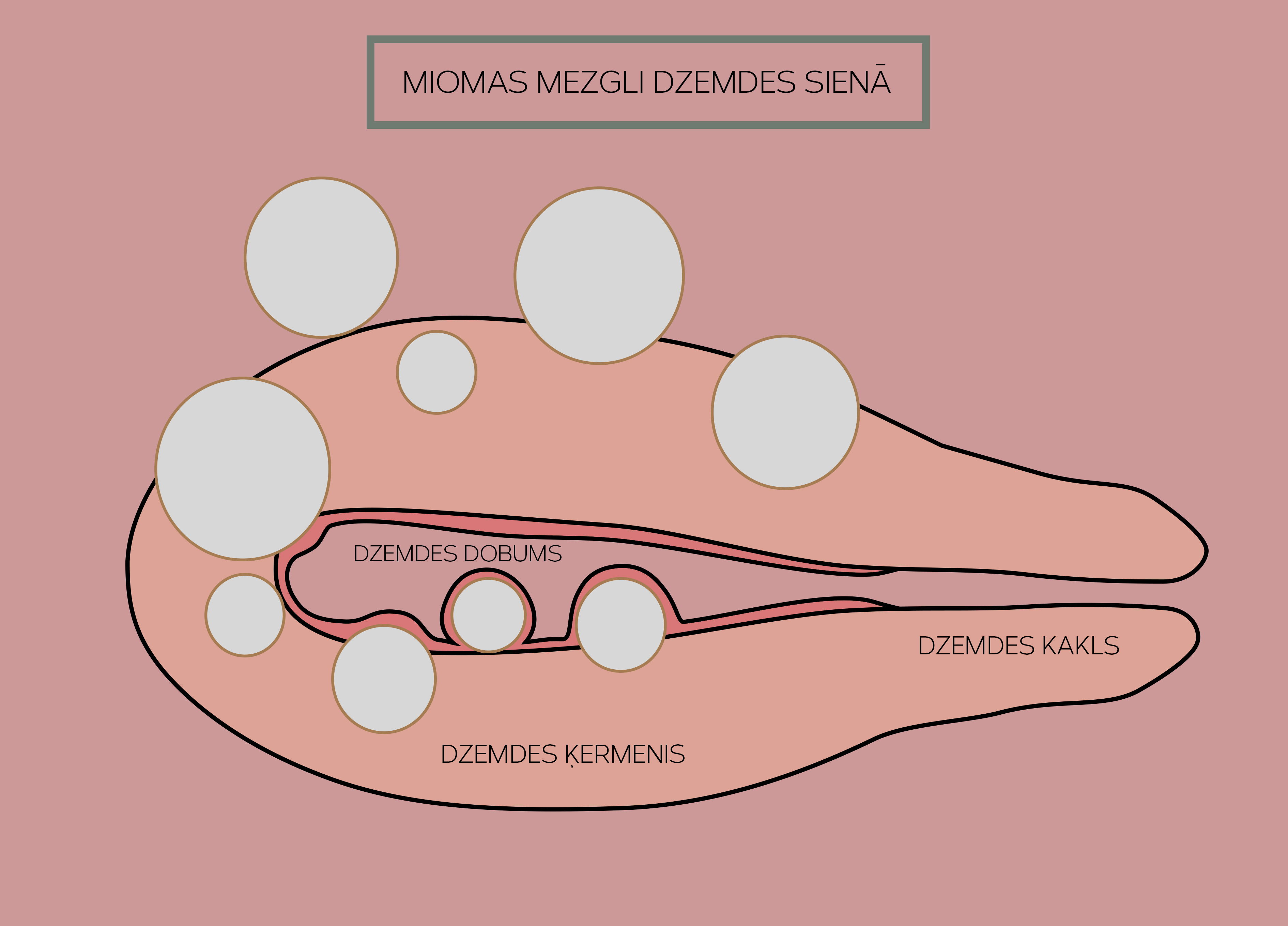 miomas mezgli dzemdes sienā