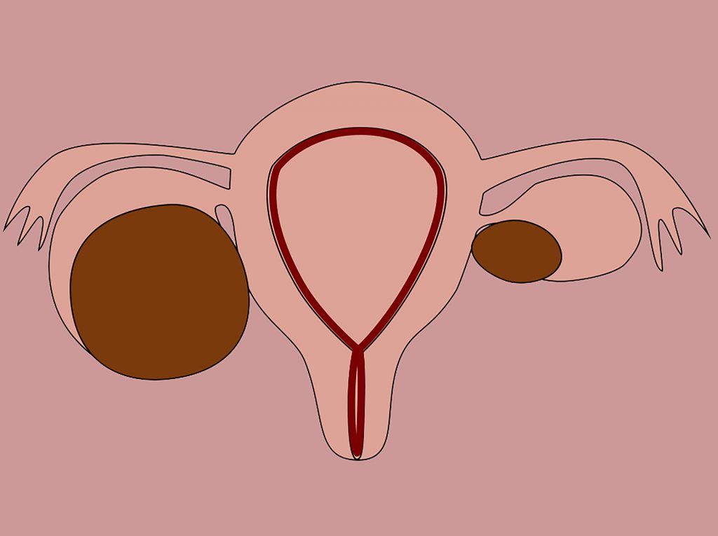 Endometrioze