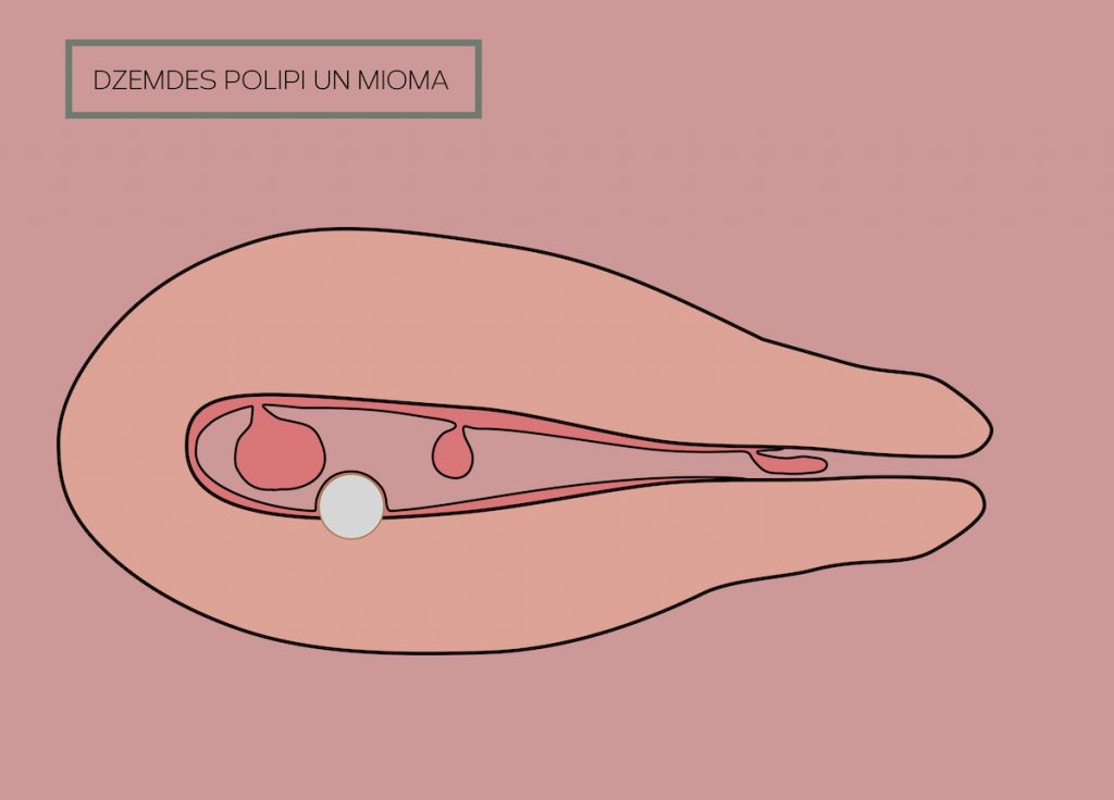 Dzemdes dobuma polips