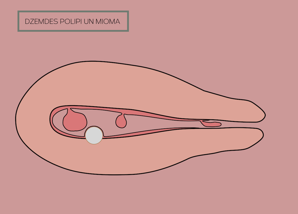 Dzemdes dobuma polips