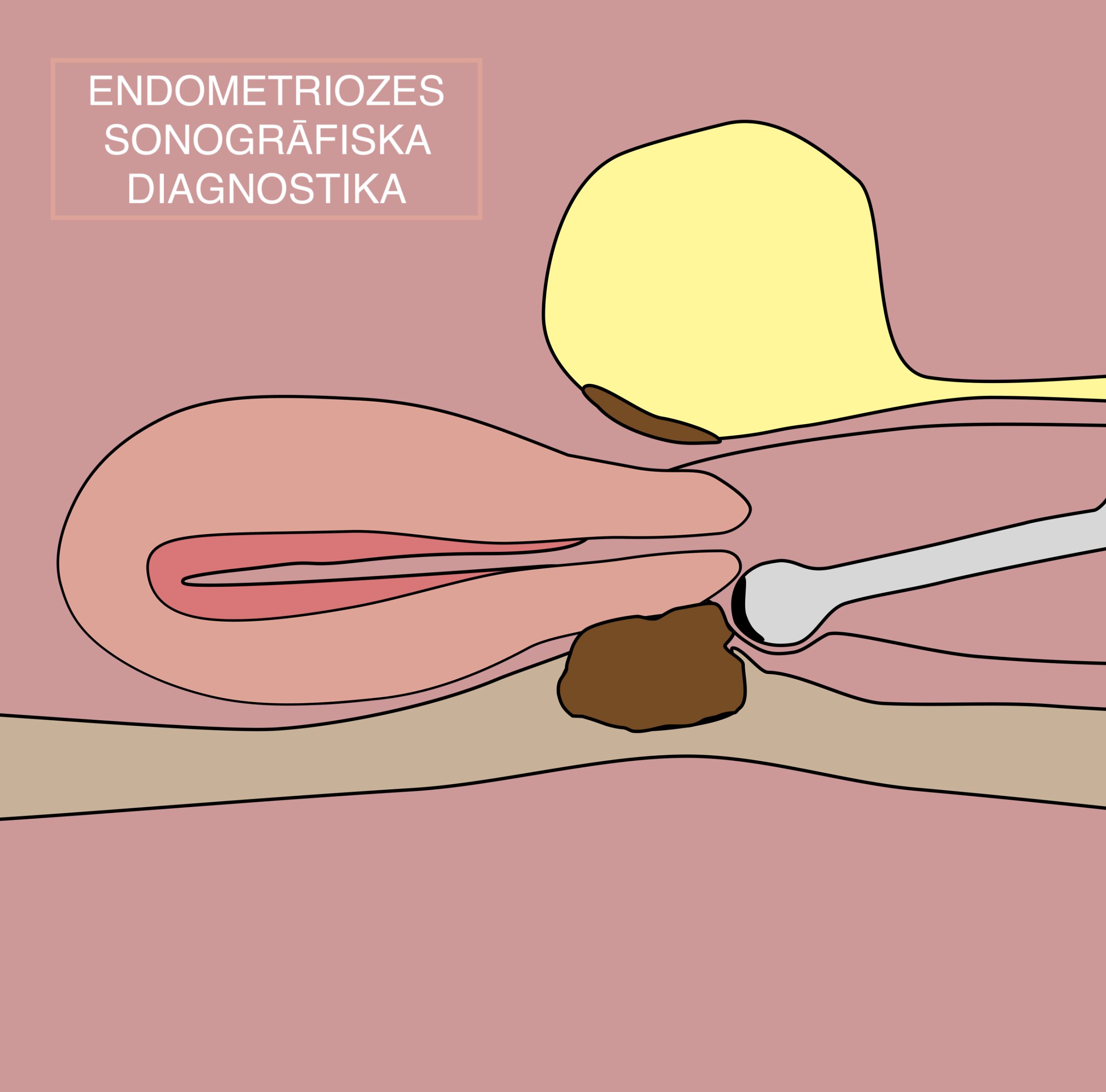 Endometriozes sonogrāfiska diagnostika.